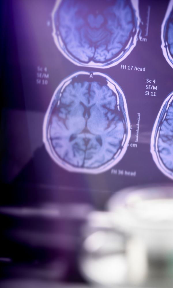 ALZHEIMER